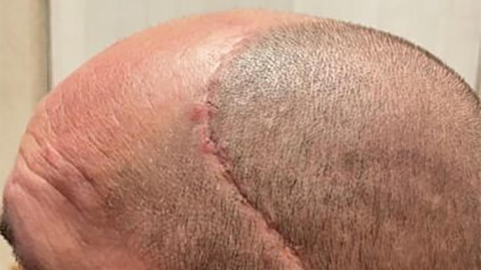 Steven Tyson injured when wall collapsed on him